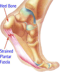 plantar fascia tension
